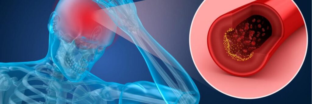 La enfermedad cerebrovascular (ECV).