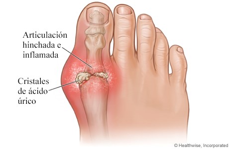 ¿Cómo combatir el ácido úrico con medicina natural?