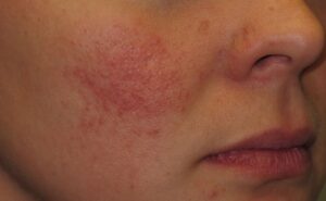 Psoriasis: una enfermedad de la piel más común de lo que piensas