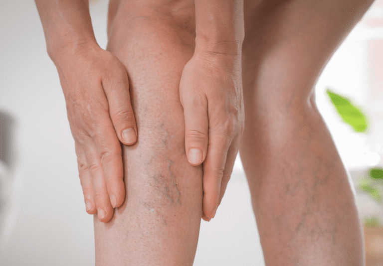 Medicina natural: Una aliada contra los trastornos circulatorios tras el chikungunya.