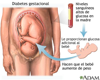 ¿Cómo manejar la diabetes gestacional? Factores de riesgo y complicaciones.