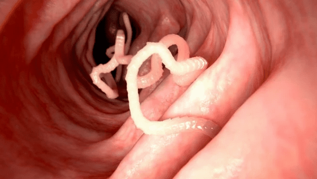 Infecciones por platelmintos: conoce cómo se trasmiten y las medidas de prevención.